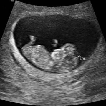 10 week ultrasound picture