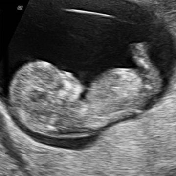 11 week ultrasound picture
