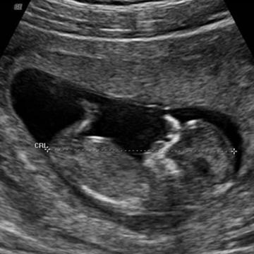 12 week ultrasound picture