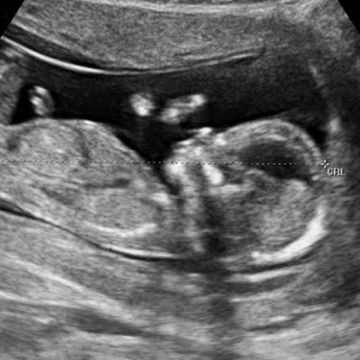 13 week ultrasound picture