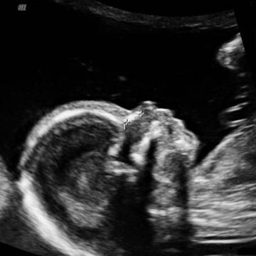 ultrasound image on week 16