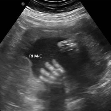pregnancy ultrasound image week 17
