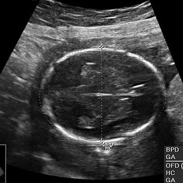 ultrasound image at week 28