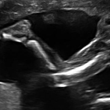 ultrasound scan image for week 19