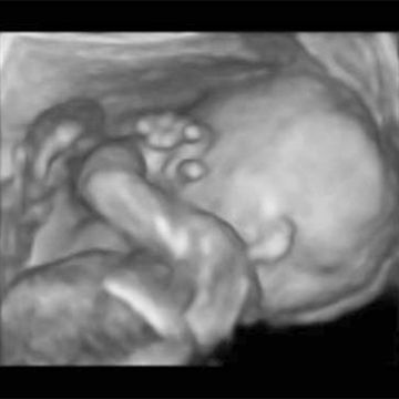 ultrasound scan for week 20