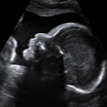 ultrasound image on week 27