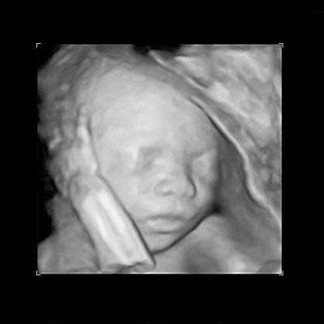 ultrasound image at week 28y