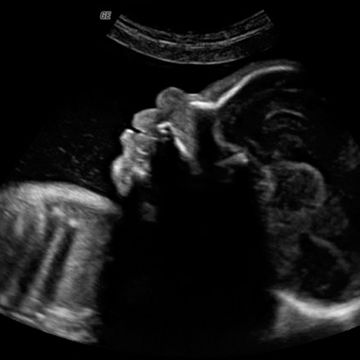 ultrasound image on week 29