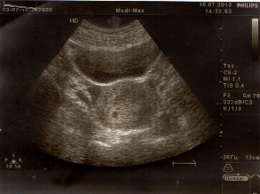 3 week ultrasound picture