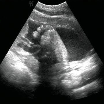 ultrasound image at week 32