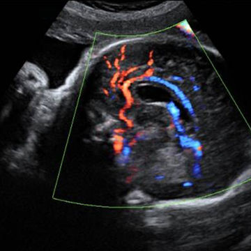 ultrasound scan image on week 33