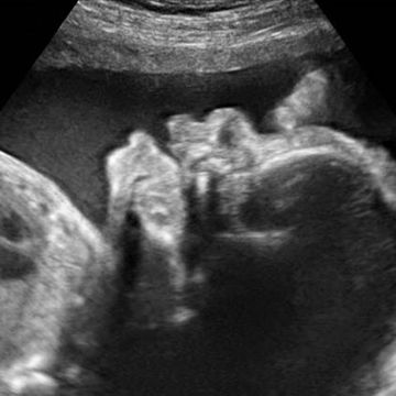ultrasound image on week 34