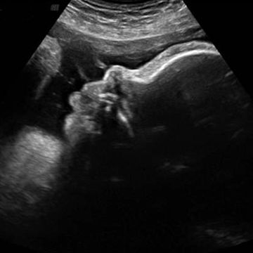 ultrasound 36 weeks pregnancy