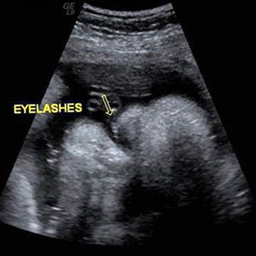 ultrasound week 39